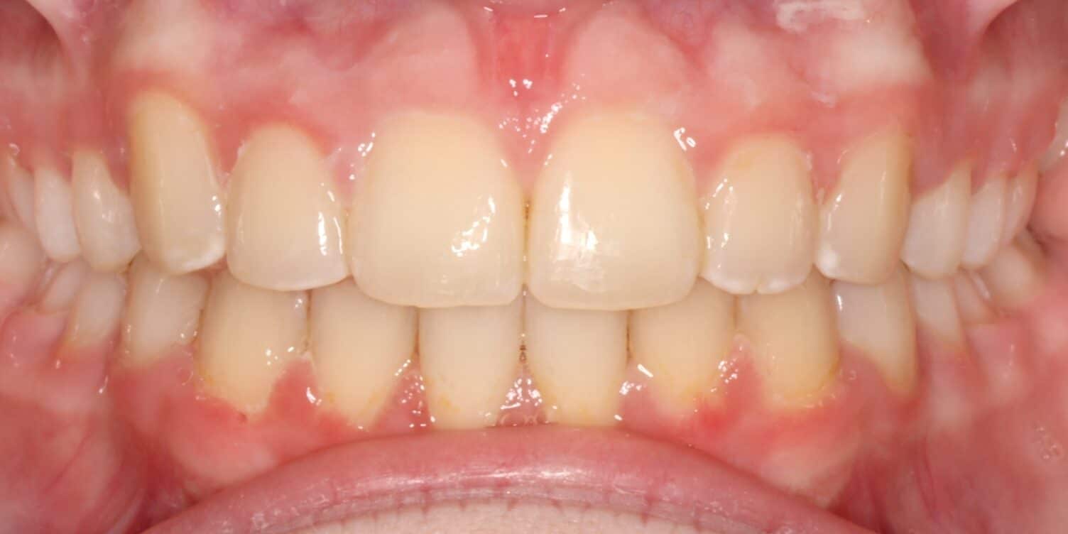 After treatment: straight, evenly aligned teeth