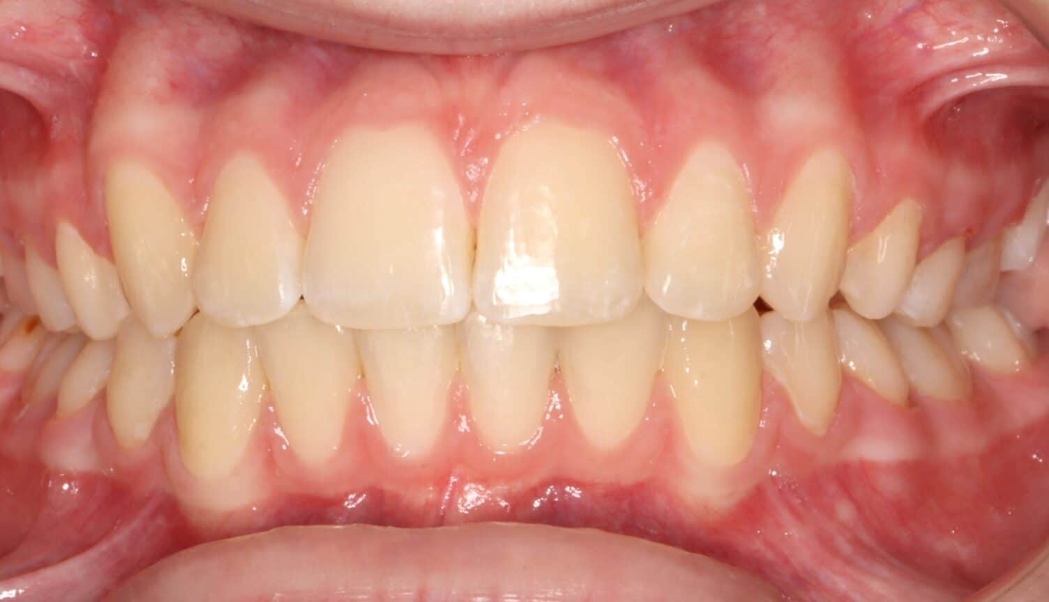 After treatment: straight, evenly aligned teeth