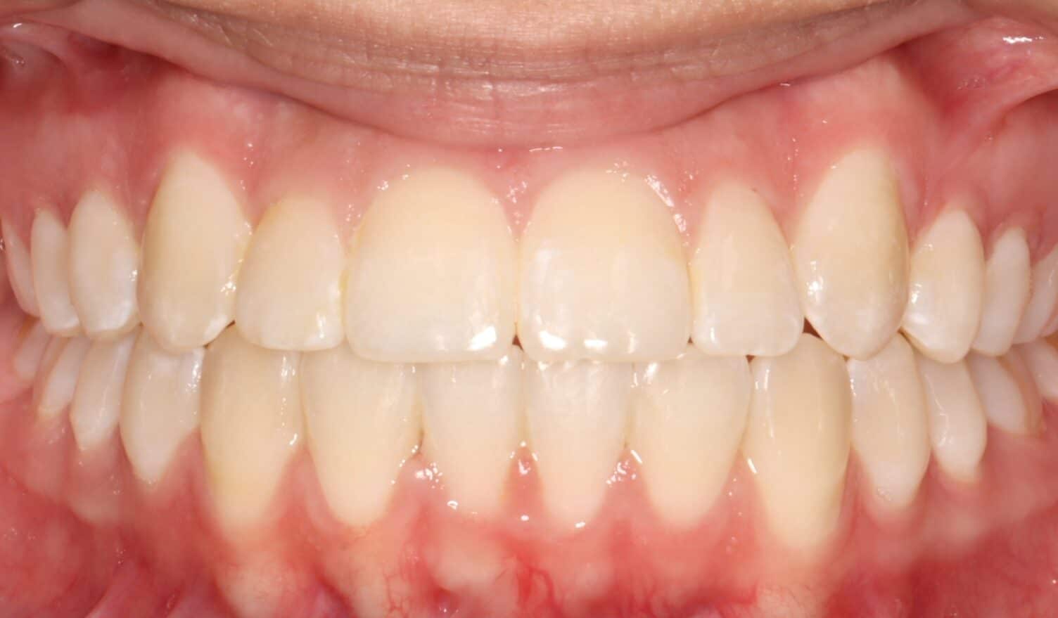 After treatment: straight, evenly aligned teeth