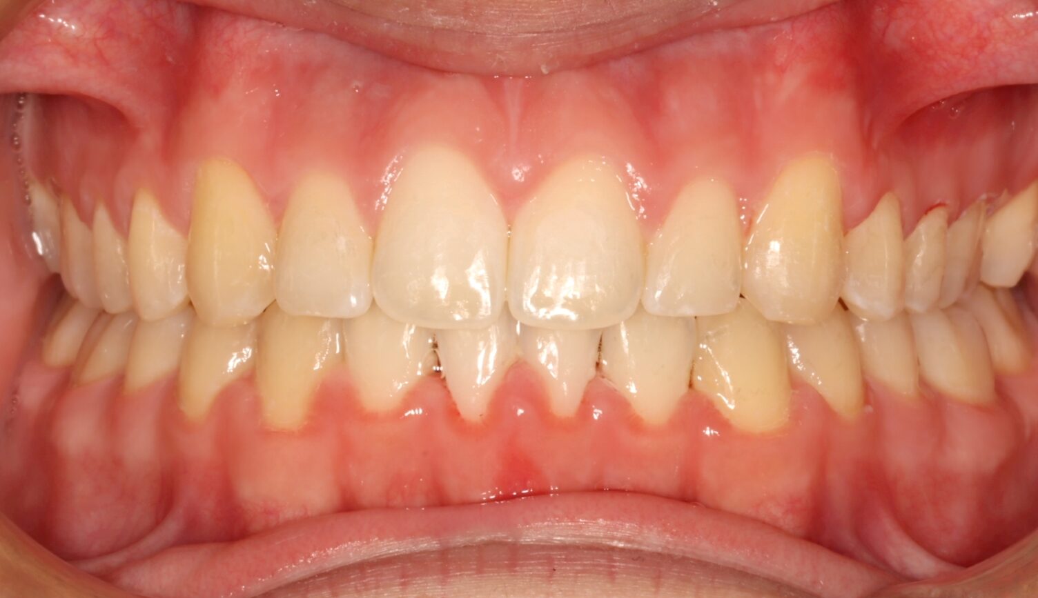 After treatment: straight, evenly aligned teeth