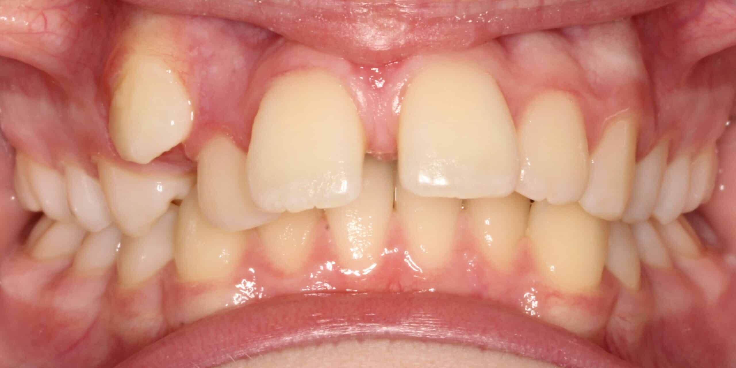 Before treatment: crooked teeth with an upper tooth out of line