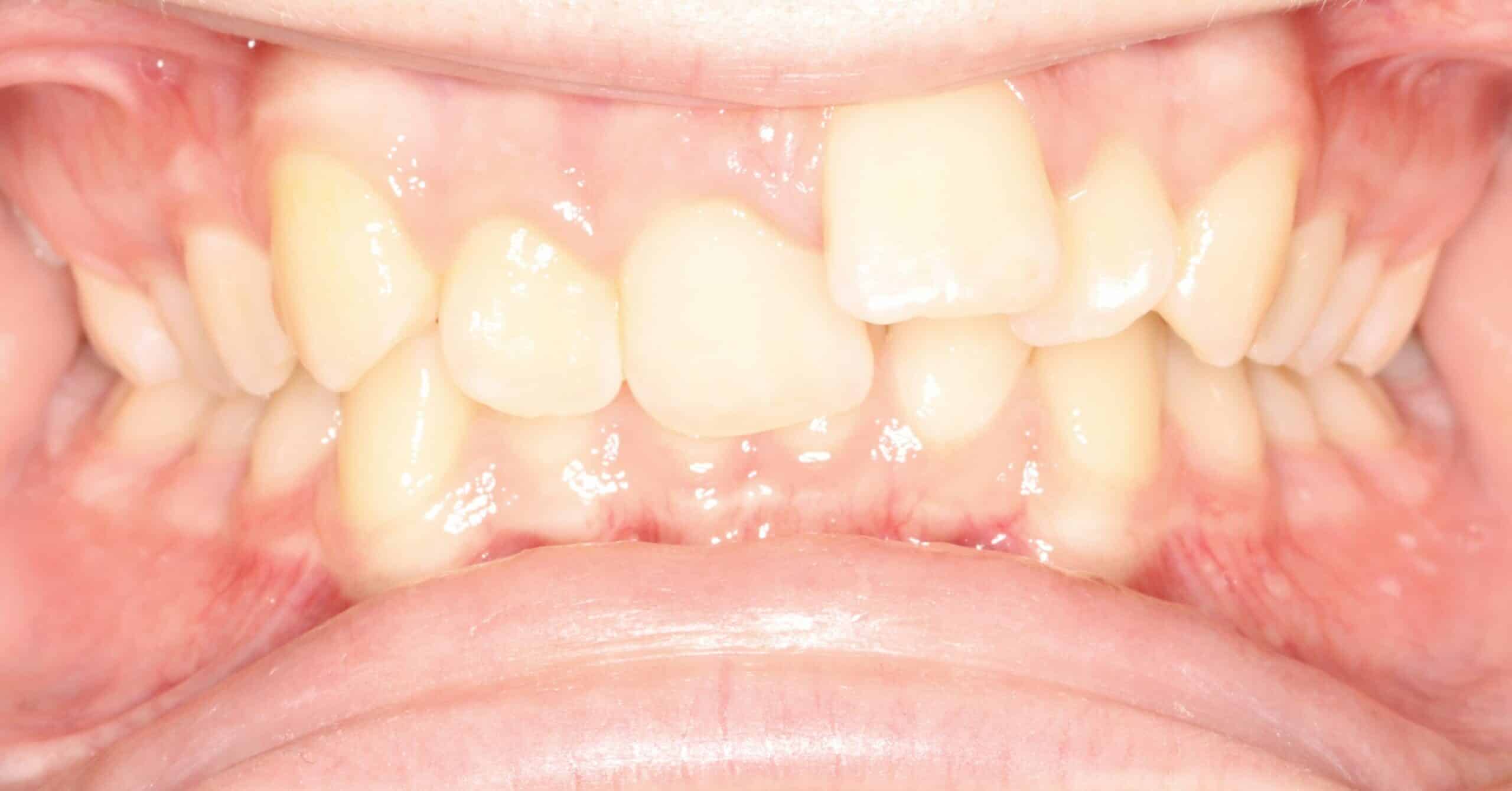 Before treatment: crowded upper and lower teeth