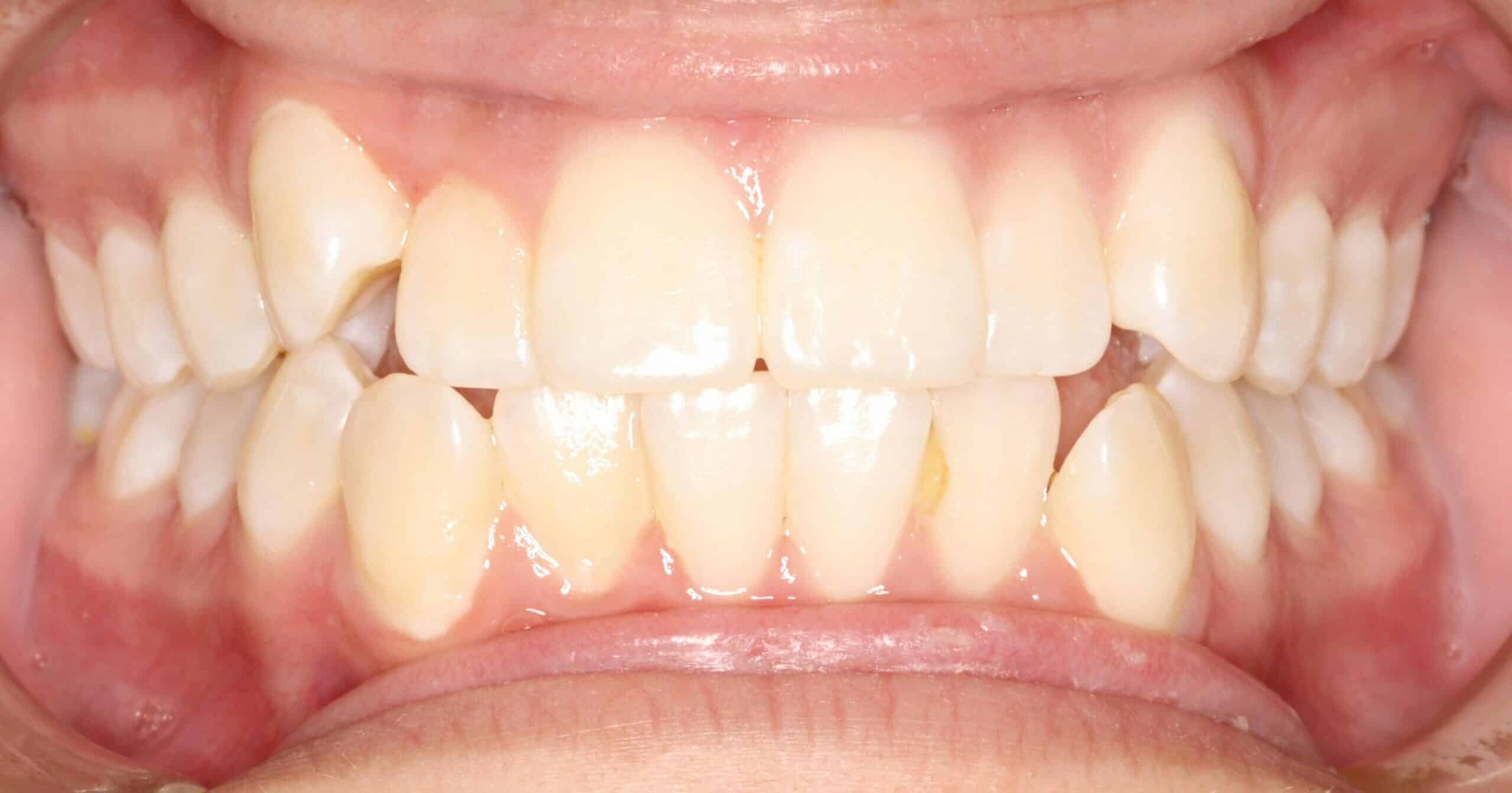 Before treatment: crowded, rotated front teeth