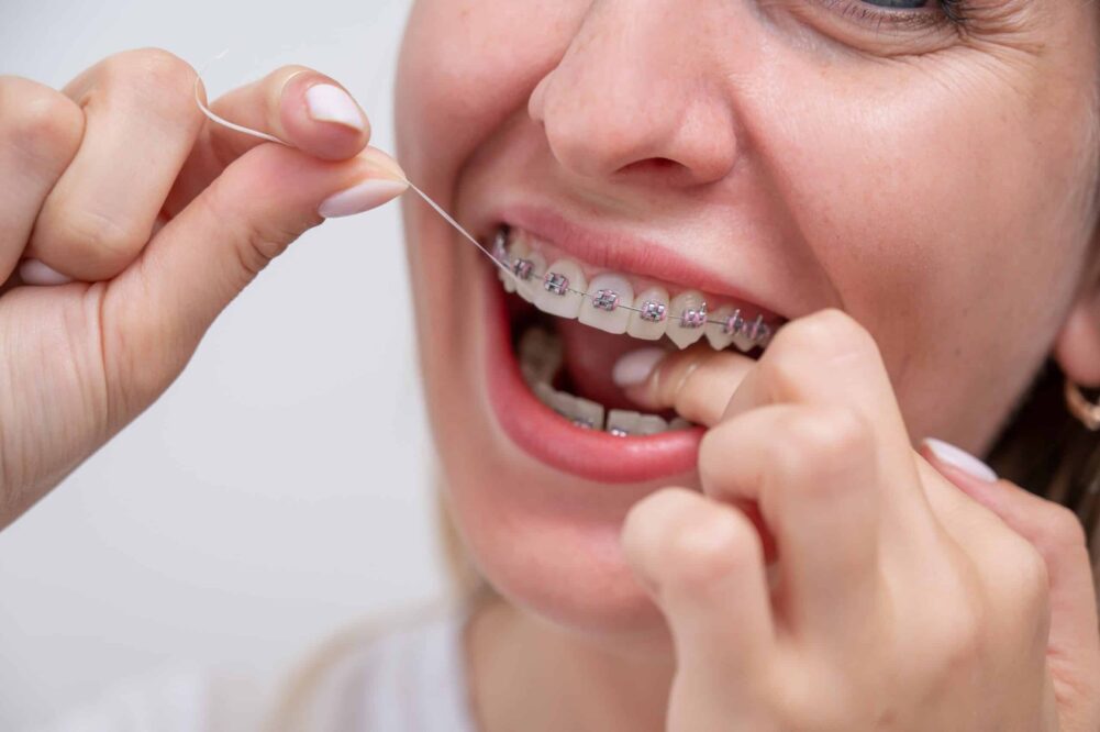 Oral Hygiene With Braces Lufkin and Nacogdoches