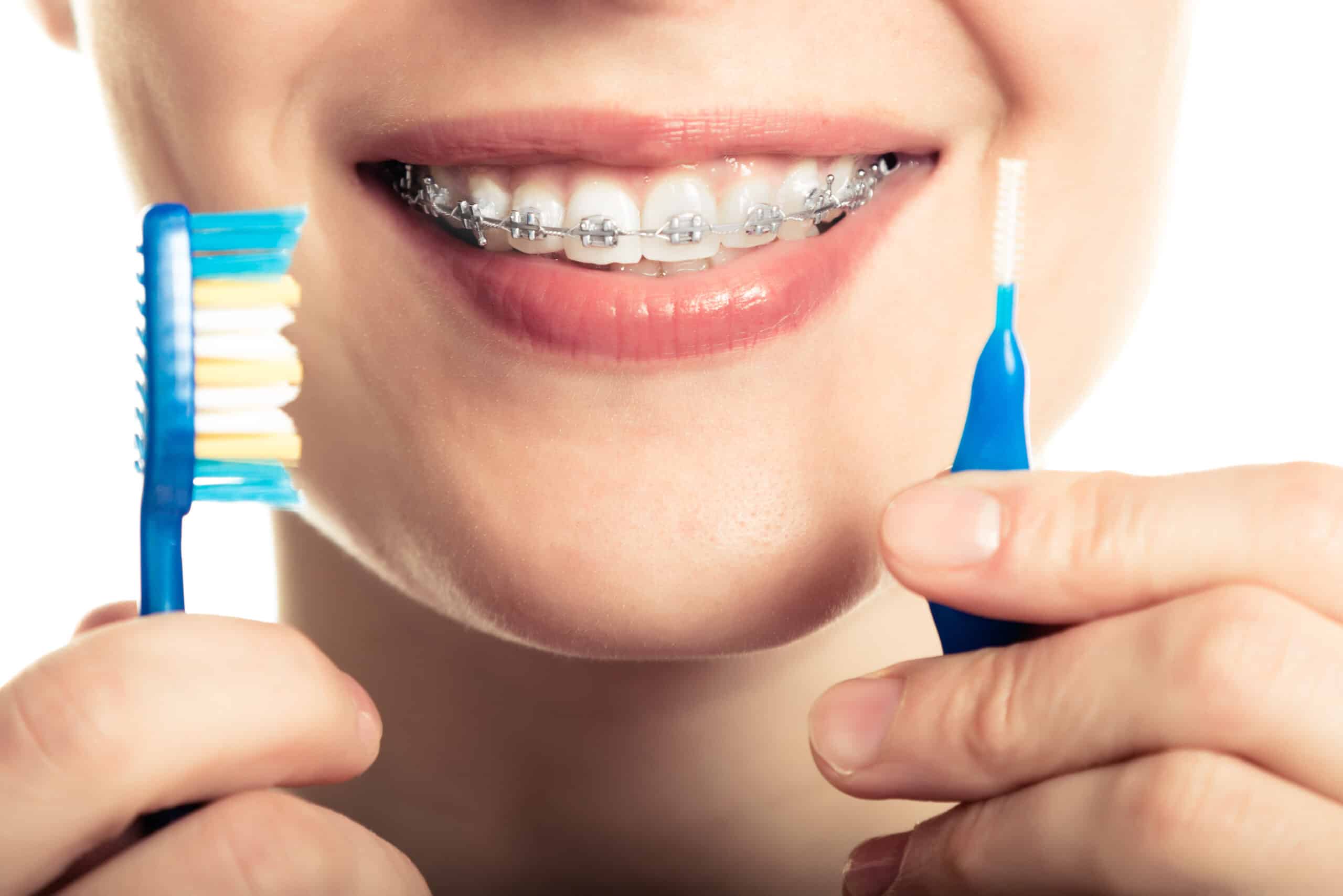 Braces in in Lufkin and Nacogdoches
