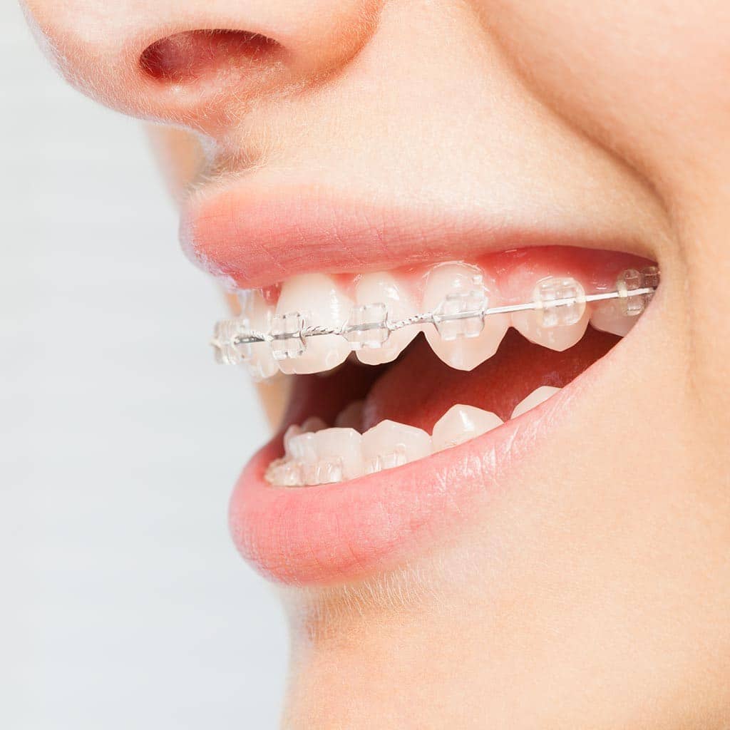 Clear Ceramic Braces