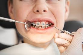 Braces for Kids in Lufkin: Helping Every Kid Smile