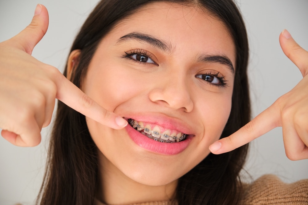 Keep Your Smile Bright: Oral Hygiene With Braces in Lufkin