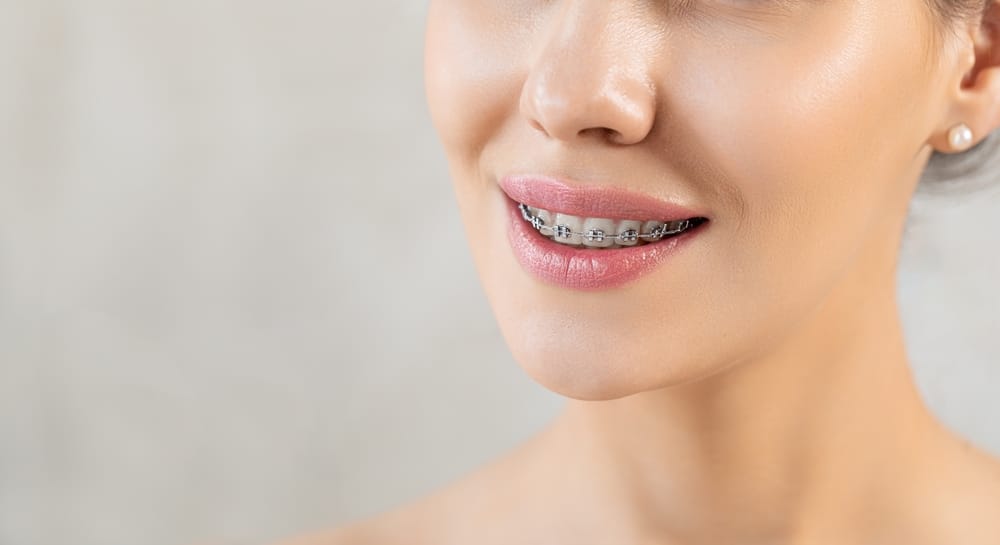 Orthodontics in Lufkin: Straightforward Care, Close to Home