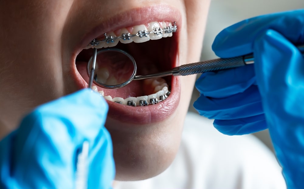 What to Look for in an Orthodontist in Nacogdoches