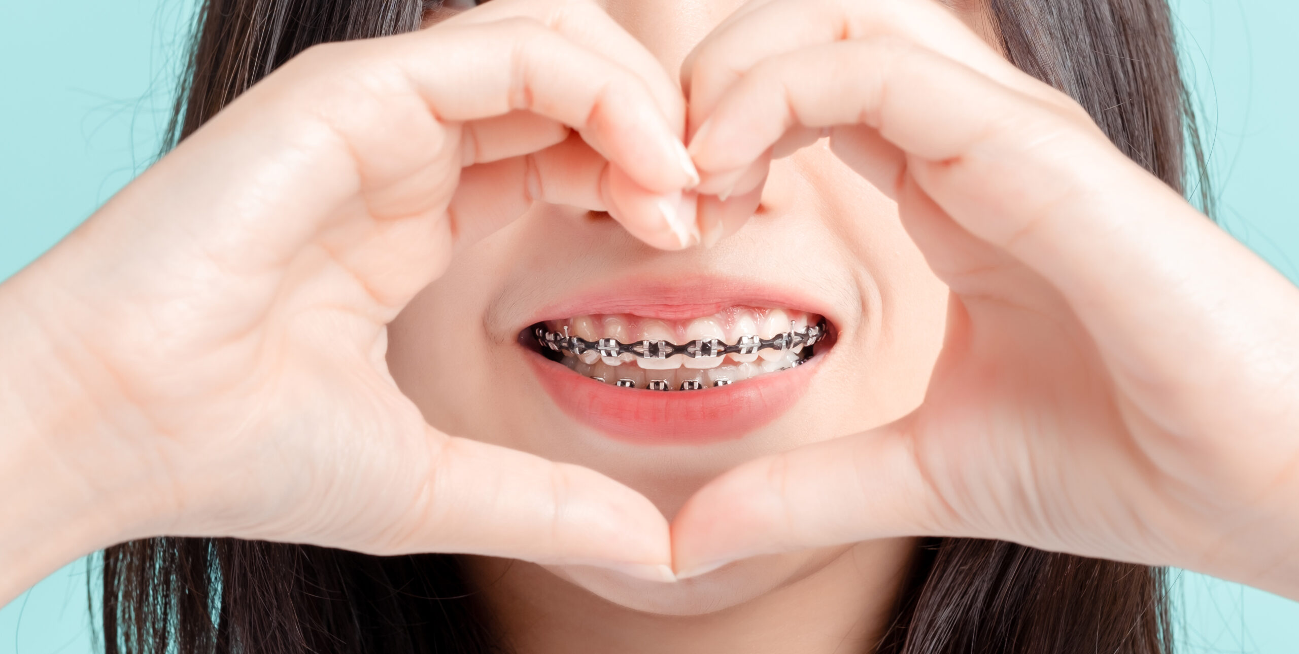 Metal Braces in Nacogdoches